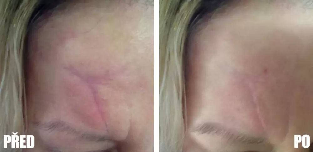 Zjemnění jizvy mikrojehličkování s vlastní krevní plazmou. Jizva je po zákroku bledší, hladší, plošší a měkčí.