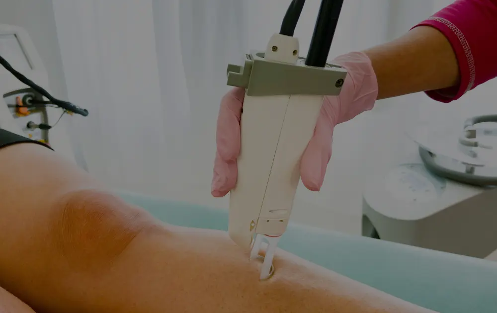 Laserov&aacute; epilace